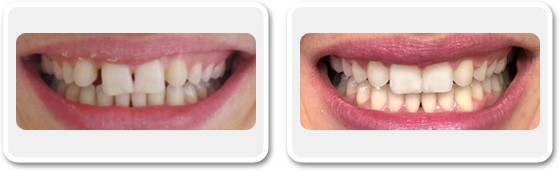 Amélioration de l’alignement des dents