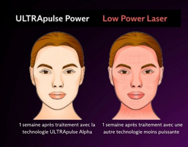 Les suites du laser Ultra Pulse