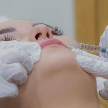 Pour obtenir des lèvres plus volumineuses sans chirurgie, les injections d’acide hyaluronique c’est la solution à Lyon | Clinique des Champs-Elysées